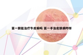 苗一肤能治疗牛皮癣吗 苗一手治皮肤病咋样