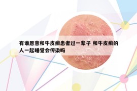 有谁愿意和牛皮癣患者过一辈子 和牛皮癣的人一起睡觉会传染吗