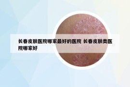 长春皮肤医院哪家最好的医院 长春皮肤类医院哪家好