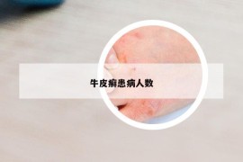 牛皮癣患病人数