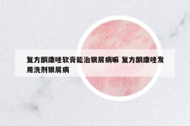 复方酮康唑软膏能治银屑病嘛 复方酮康唑发用洗剂银屑病
