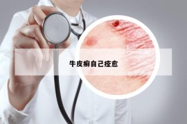 牛皮癣自己痊愈