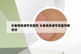 长春银屑病专家医院 长春银屑病专家医院哪家好