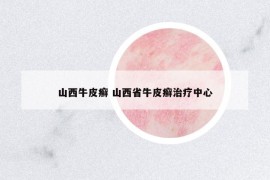 山西牛皮癣 山西省牛皮癣治疗中心