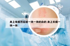 身上有癣然后就一块一块的白的 身上长癣一块一块