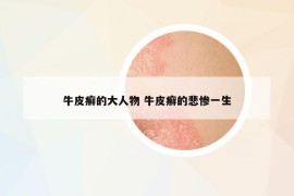 牛皮癣的大人物 牛皮癣的悲惨一生