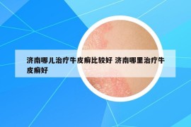济南哪儿治疗牛皮癣比较好 济南哪里治疗牛皮癣好