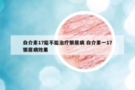 白介素17能不能治疗银屑病 白介素一17银屑病效果