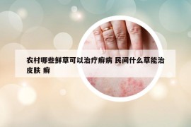 农村哪些鲜草可以治疗癣病 民间什么草能治皮肤 癣