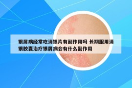 银屑病经常吃消银片有副作用吗 长期服用消银胶囊治疗银屑病会有什么副作用
