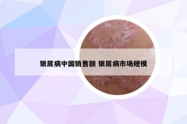 银屑病中国销售额 银屑病市场规模
