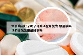 银屑病治好了喝了母鸡汤全身复发 银屑病喝汤药全发出来是好事吗