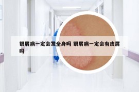 银屑病一定会发全身吗 银屑病一定会有皮屑吗