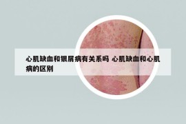心肌缺血和银屑病有关系吗 心肌缺血和心肌病的区别