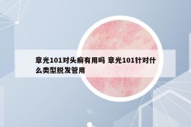 章光101对头癣有用吗 章光101针对什么类型脱发管用