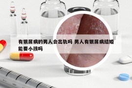 有银屑病的男人会出轨吗 男人有银屑病结婚能要小孩吗