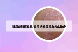 银屑病鳞屑现象 银屑病鳞屑现象怎么治疗