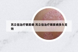 苏立信治疗银屑病 苏立信治疗银屑病多久见效