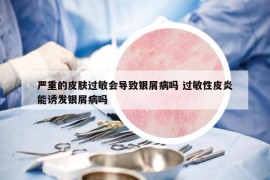严重的皮肤过敏会导致银屑病吗 过敏性皮炎能诱发银屑病吗