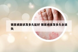 银屑病束状发多久能好 银屑病束发多久会消失