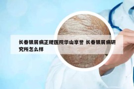 长春银屑病正规医院华山享誉 长春银屑病研究所怎么样