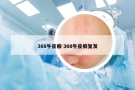 308牛皮癣 308牛皮癣复发