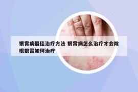 银霄病最佳治疗方法 银霄病怎么治疗才会除根银霄如何治疗