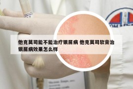 他克莫司能不能治疗银屑病 他克莫司软膏治银屑病效果怎么样