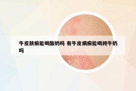 牛皮肤癣能喝酸奶吗 有牛皮病癣能喝纯牛奶吗