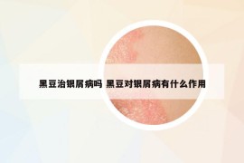 黑豆治银屑病吗 黑豆对银屑病有什么作用