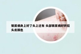 银屑病身上好了头上还有 头部银屑病好转后头皮颜色