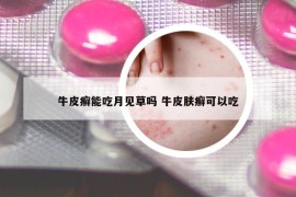 牛皮癣能吃月见草吗 牛皮肤癣可以吃