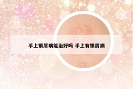 手上银屑病能治好吗 手上有银屑病
