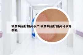 银屑病治疗期间小产 银屑病治疗期间可以怀孕吗
