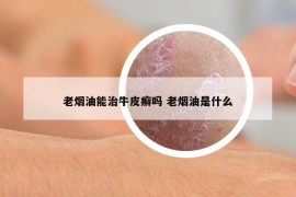 老烟油能治牛皮癣吗 老烟油是什么