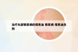 治疗头部银屑病的煤焦油 银屑病 煤焦油洗剂