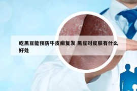 吃黑豆能预防牛皮癣复发 黑豆对皮肤有什么好处