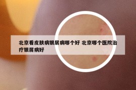 北京看皮肤病银屑病哪个好 北京哪个医院治疗银屑病好