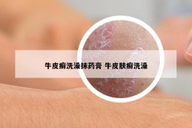 牛皮癣洗澡抹药膏 牛皮肤癣洗澡