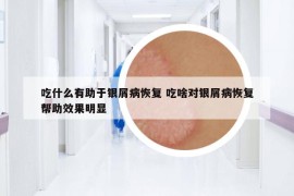 吃什么有助于银屑病恢复 吃啥对银屑病恢复帮助效果明显