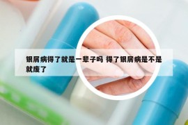 银屑病得了就是一辈子吗 得了银屑病是不是就废了