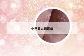 中巴里人银屑病