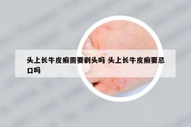 头上长牛皮癣需要剃头吗 头上长牛皮癣要忌口吗