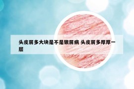 头皮屑多大块是不是银屑病 头皮屑多厚厚一层