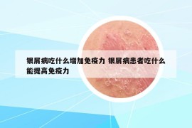 银屑病吃什么增加免疫力 银屑病患者吃什么能提高免疫力