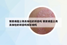 银屑病是公务员体检的项目吗 银屑病是公务员体检的项目吗有影响吗