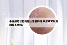 牛皮癣可以打胸腺肽注射剂吗 银屑病可以用胸腺五肽吗?
