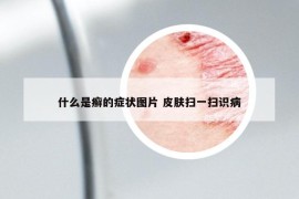 什么是癣的症状图片 皮肤扫一扫识病