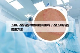 五胆八宝药墨对银屑病有用吗 八宝五胆药墨使用方法