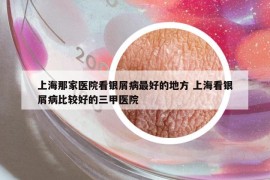 上海那家医院看银屑病最好的地方 上海看银屑病比较好的三甲医院